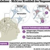 Alzheimer: Weltweit 30 Millionen betroffen