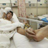 Abgetrennte Hand an Fuß von Chinese genäht