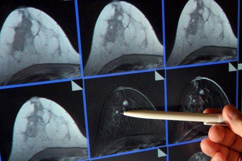 Die Mammografie ist eine wichtige Früherkennungsmaßnahme. Die Einladung dazu erfolgt alle zwei Jahre. DPA