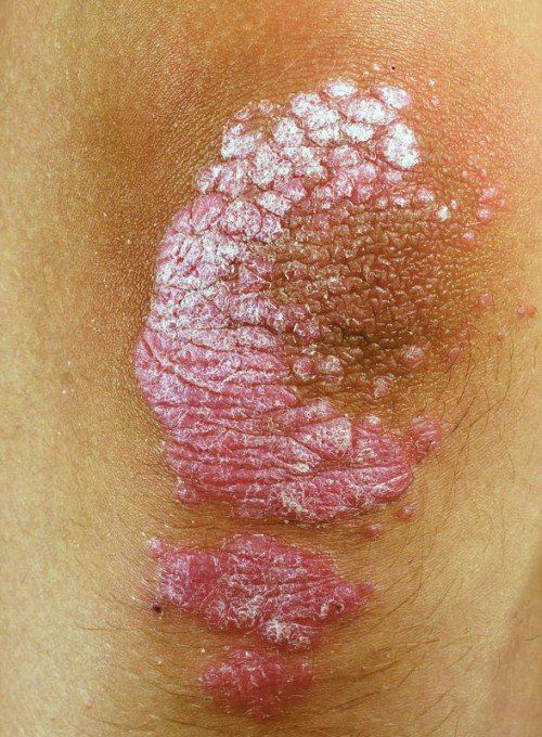psoriasis skin disorder on an elbow
