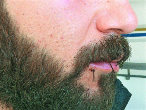 Weil sein verzweifelter Hilferuf ohnehin nicht erhört wird, nähte sich Laith* den Mund zu. Foto: privat