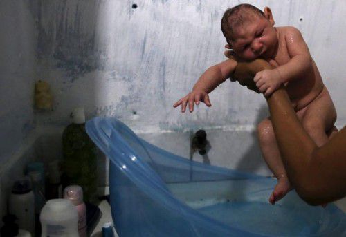 Baby mit Mikrozephalie: Das Zikavirus wird für die Schädelfehlbildung verantwortlich gemacht.