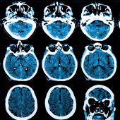 Mit Sensortechnik gegen Parkinson
