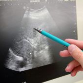 Hepatitis ist behandelbar
