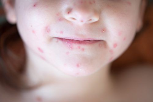 Das Masernvirus verbreitet sich leicht. Um Ausbrüche zu vermeiden, müssten laut WHO 95 Prozent der Bevölkerung in allen Alters- und sozialen Gruppen geschützt sein.