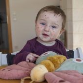 Lilijana ist ein „Schmetterlingskind“. Ihre Eltern tun alles für ein gutes Leben. »A4
