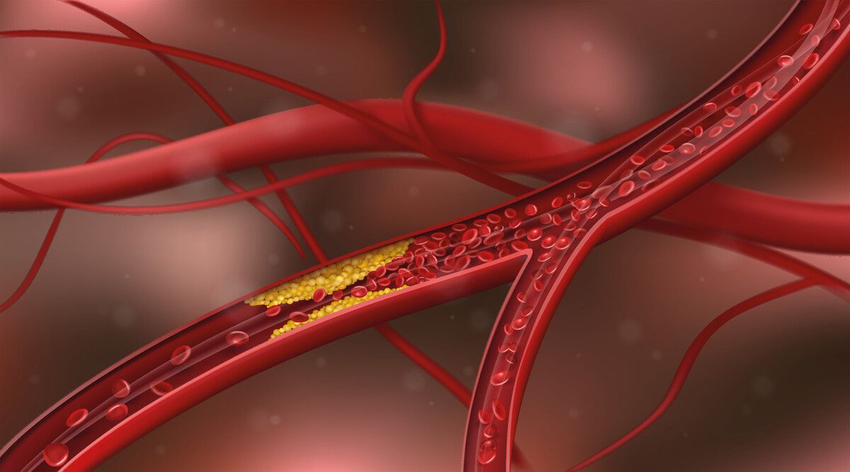 Bei Atherosklerose kommt es an den Innenwänden der arteriellen Blutgefäße zu übermäßigen Ablagerungen von Fetten und anderen Substanzen.