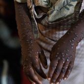 Mpox-Alarm in Kongo: UNHCR meldet dutzende Verdachtsfälle