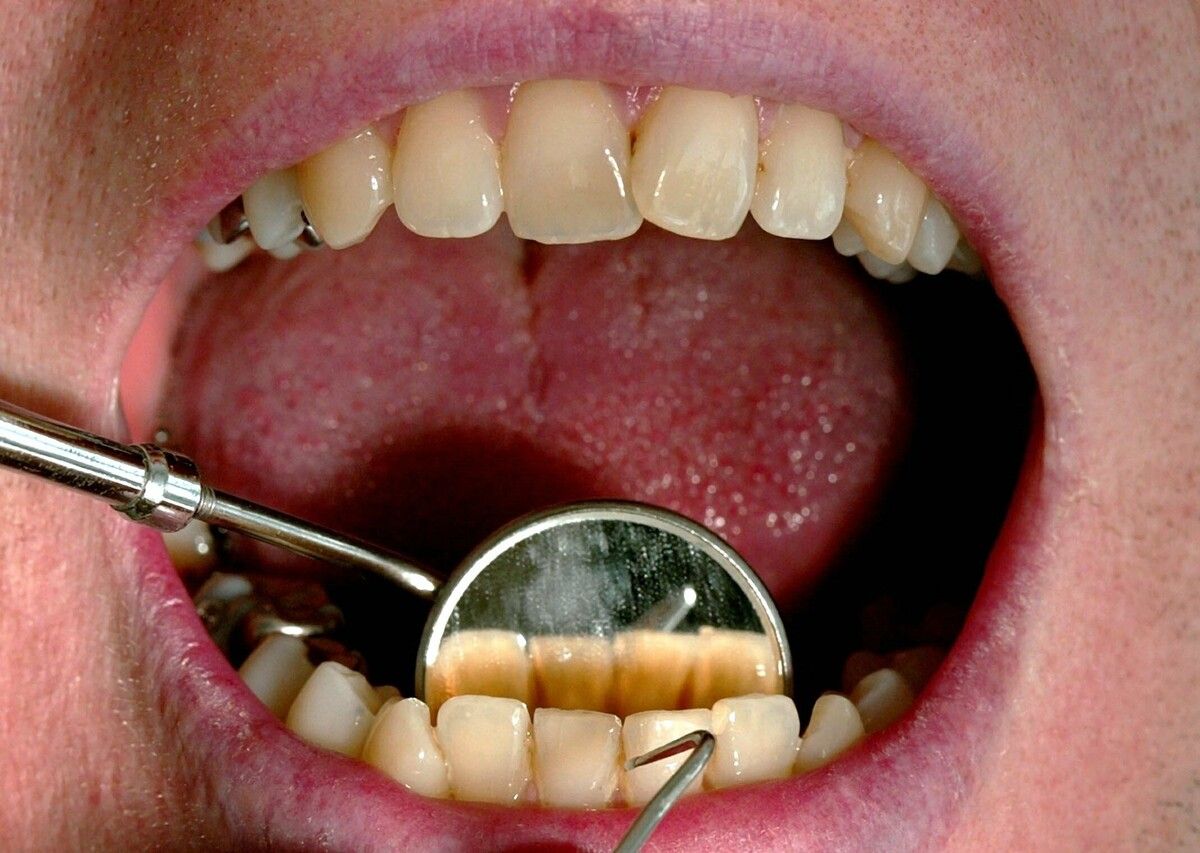 Amalgam als Füllmaterial hat in einigen Tagen endgültig ausgedient. In Vorarlberg geht das ohne Zwist.⇒dpa