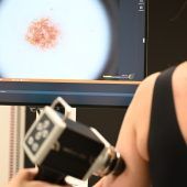 KI nimmt Muttermale unter die Lupe