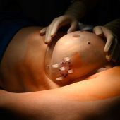 Erfolge mit Tumor-Lokalisator